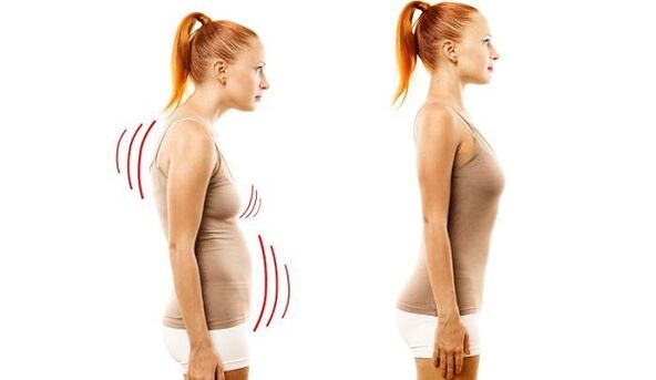 прав гръб и лоша стойка с цервикална остеохондроза