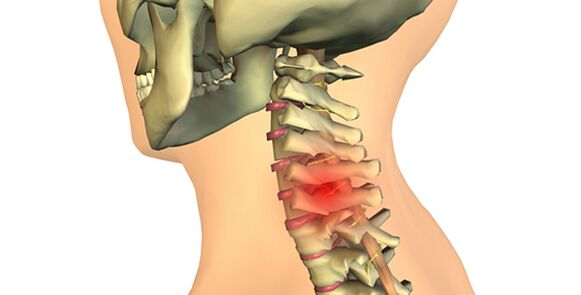 промени в гръбначния стълб с цервикална остеохондроза