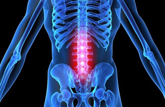 В напреднал стадий на остеохондроза на лумбалния гръбначен стълб двигателната активност на човек се влошава. 